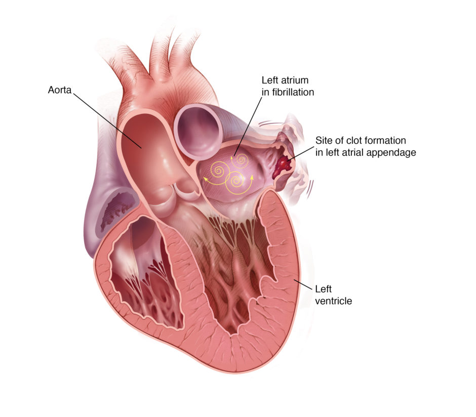 More than 90% of stroke-causing clots that come from the heart are formed in the LAA.
